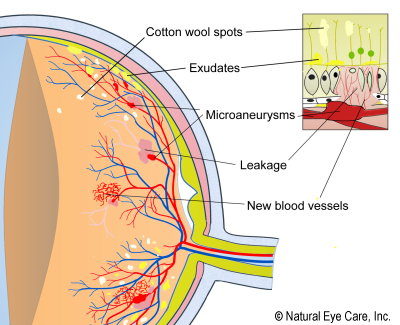 diabetic retinopathy