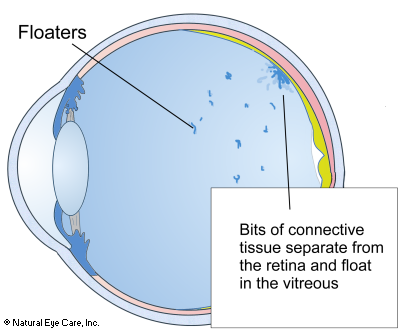 eye floaters