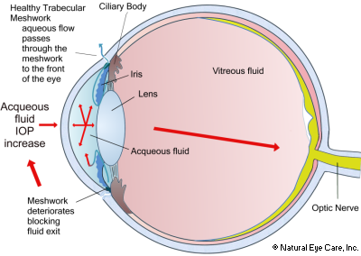 Glaucoma