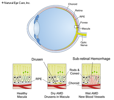 Macular Degeneration