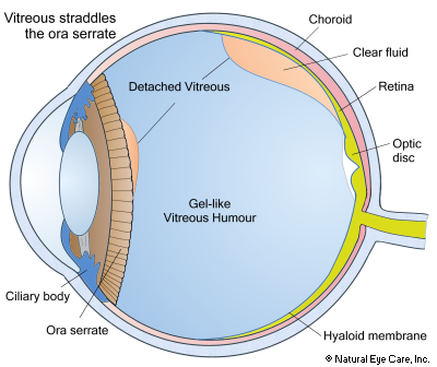 Vitreous Detachment