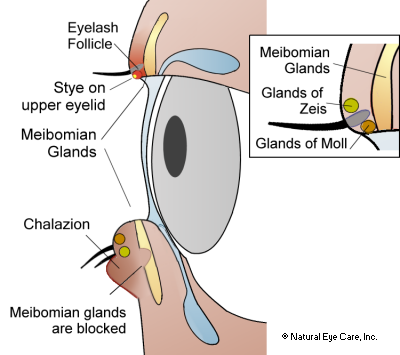 Chalazion, Eye Sty